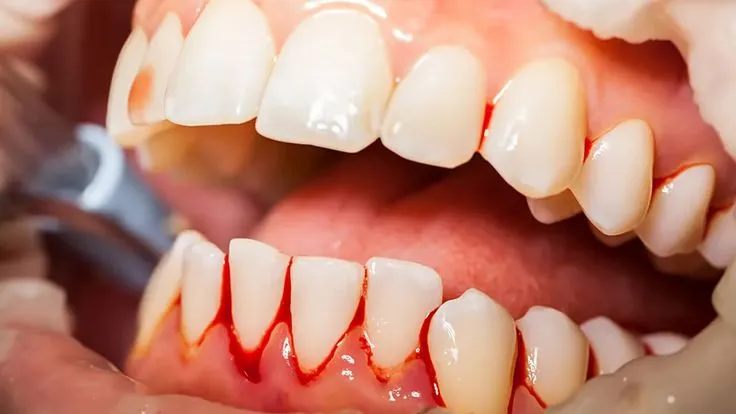 Treatment of Bleeding Gums