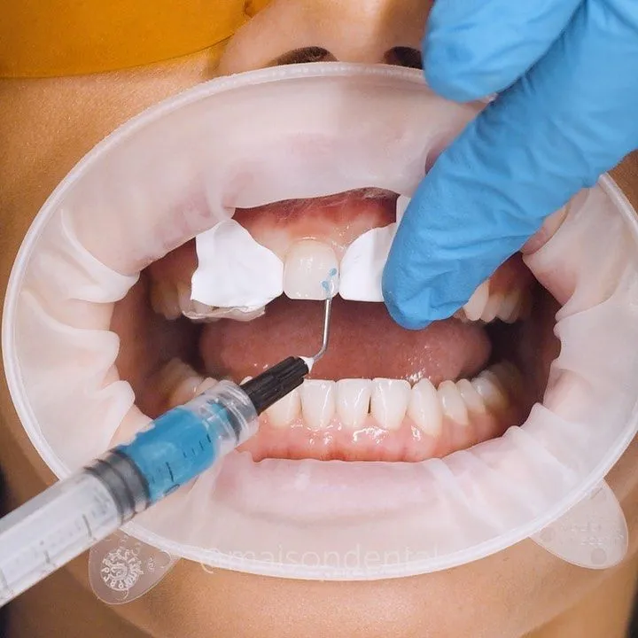 GIC or Composite Filling