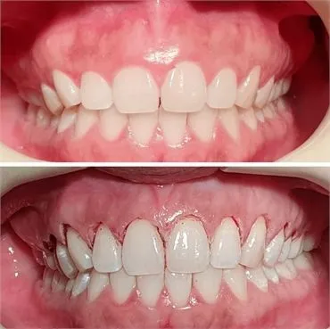Gingival Surgery