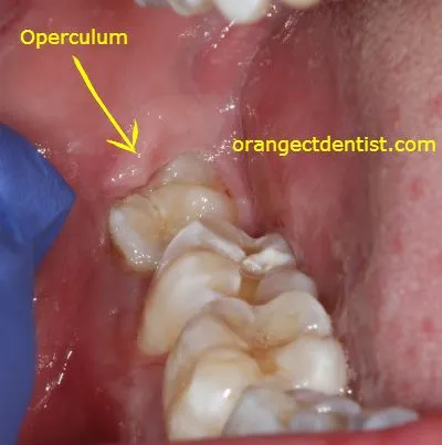 Operculectomy