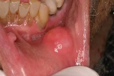Oral Cancer Counselling