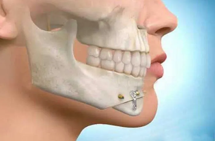 Oral Surgical Procedures