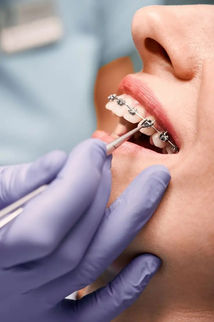 Orthodontic Treatment