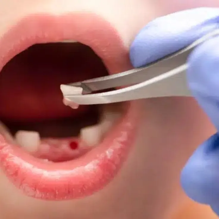 Simple Extraction