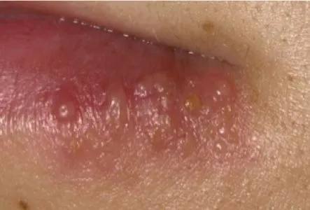 Treatment of Oral Lesions