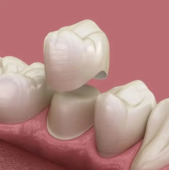 Zirconia, PFM, Metal & Gold Crown